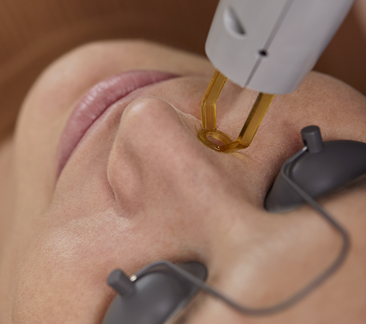 Laser handpiece positioned near a facial treatment area