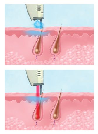 Diagram illustrating cryogen cooling during laser treatment