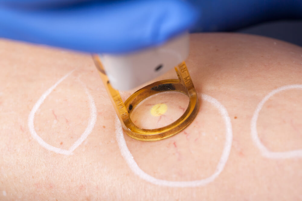 Laser handpiece positioned over a leg treatment area
