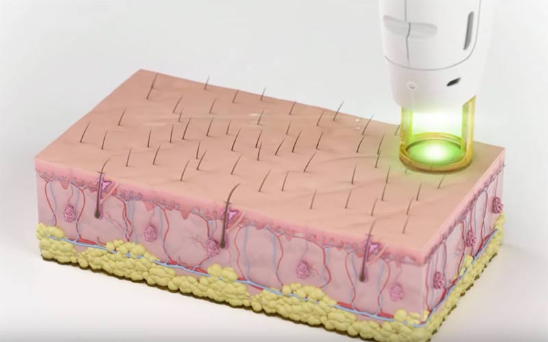 Illustration of laser energy targeting a hair follicle