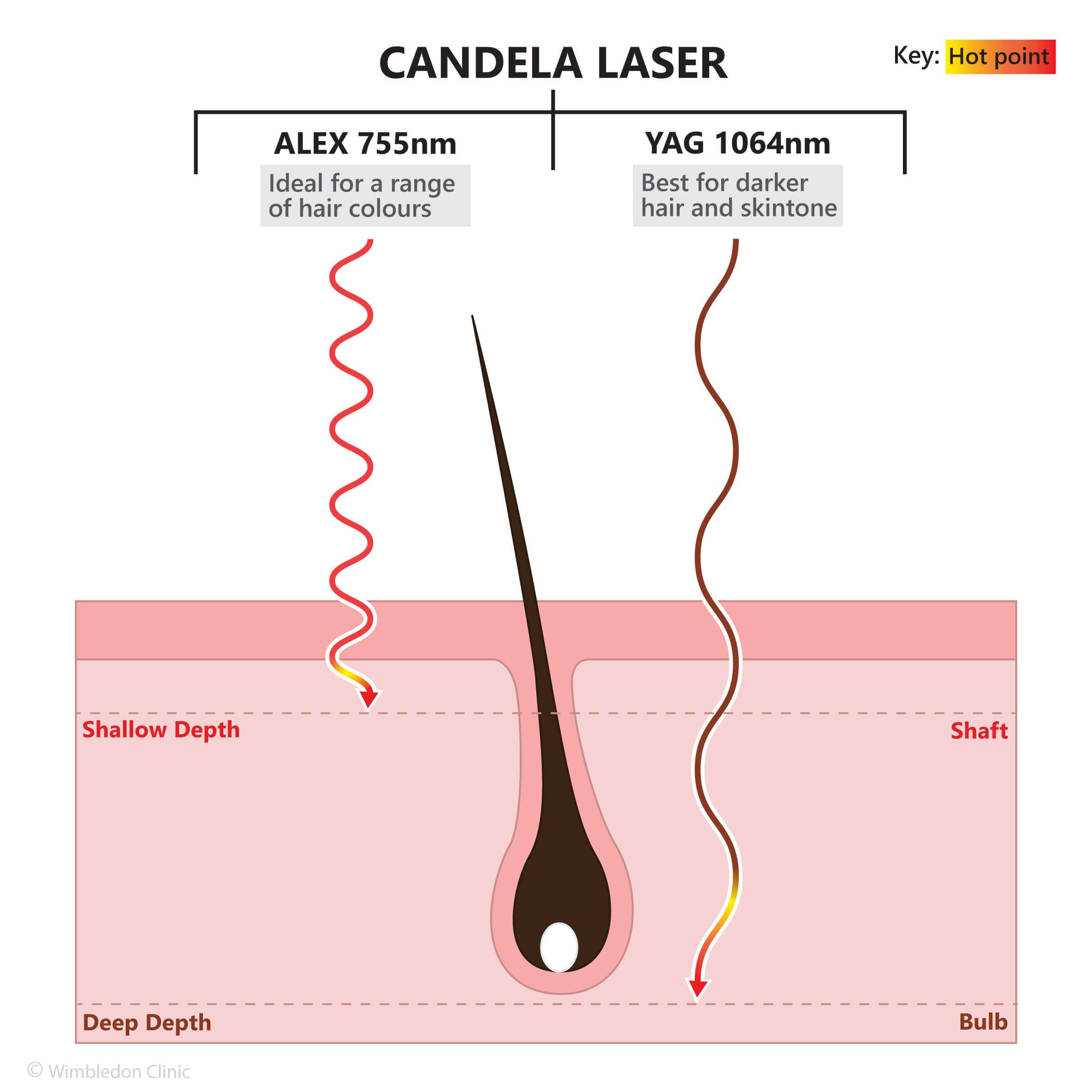 Diagram comparing Alexandrite and Nd:YAG laser wavelengths