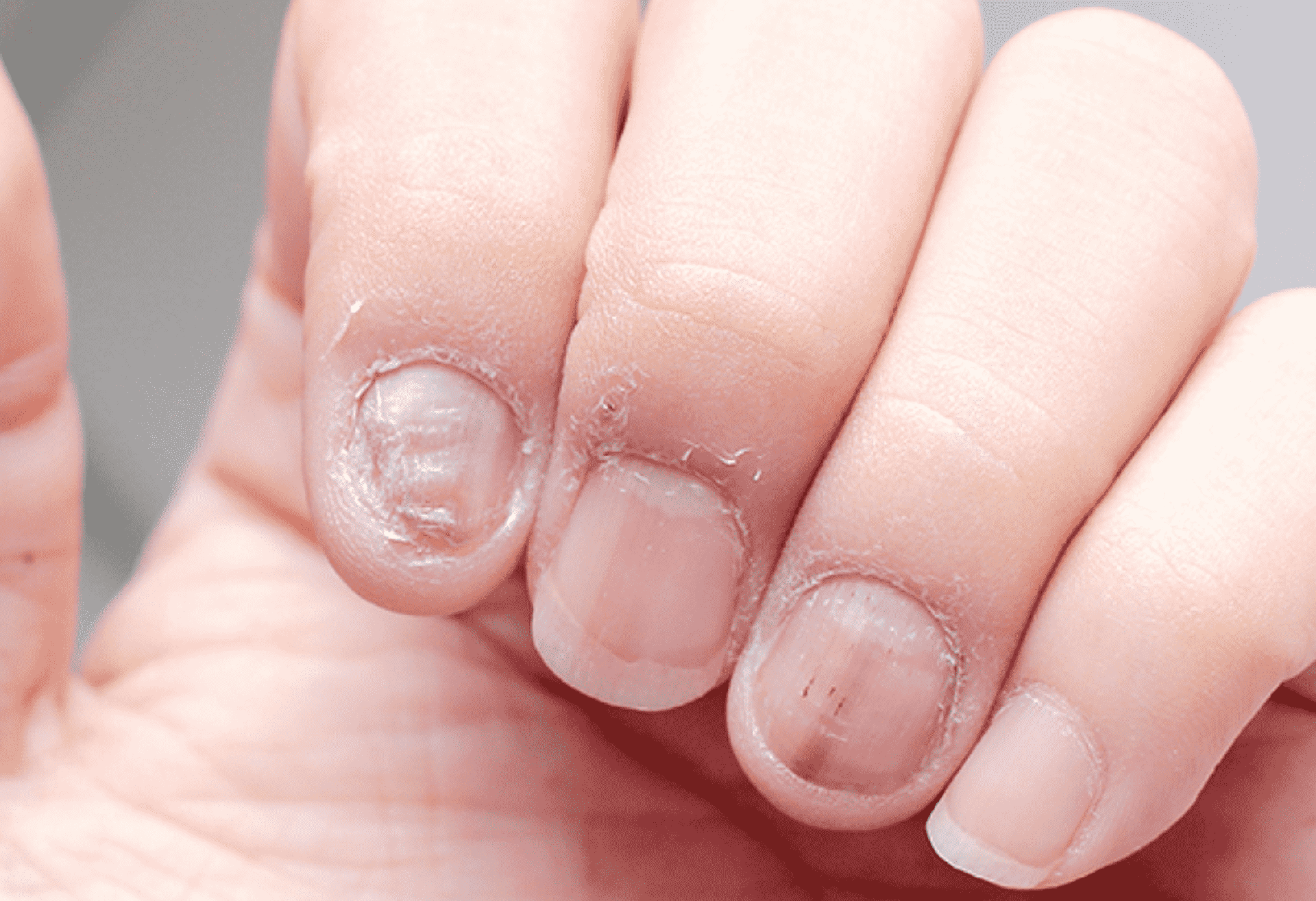 Fungal Nail Infection Progen Aesthetics