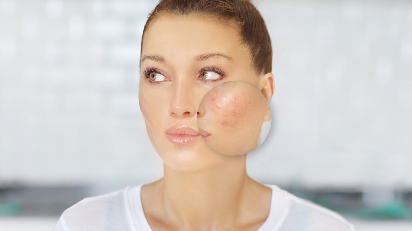 Before Treatment: Beautiful Face with Visible Thread Veins Ready for Transformation! This image captures the natural beauty of a face marked by thread veins, set for rejuvenation with Candela GentleMax Pro Plus treatment. The powerful, non-invasive laser technology promises to enhance skin clarity and restore a smooth, flawless complexion.