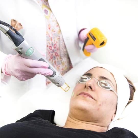 Experience Transformation: Middle-Aged Woman Receives Rosacea Treatment with Candela GentleMax Pro Plus!