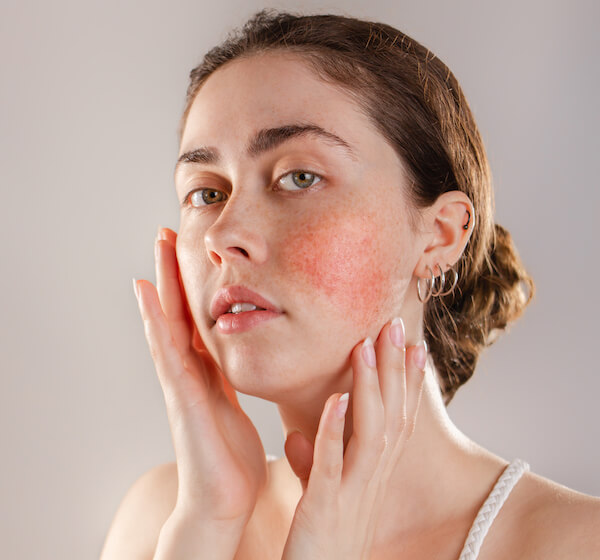 This image captures the delicate beauty of a face affected by rosacea, demonstrating the potential for transformation. The Candela GentleMax Pro Plus laser is poised to soothe redness and improve skin texture, offering a promising solution for those seeking to alleviate symptoms of rosacea and restore their natural glow.